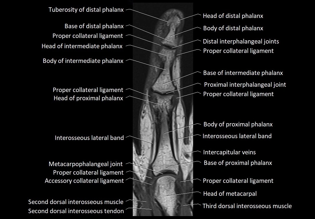 Finger anatomy coronal cross section 3TMRI labelled  image 5.webp
